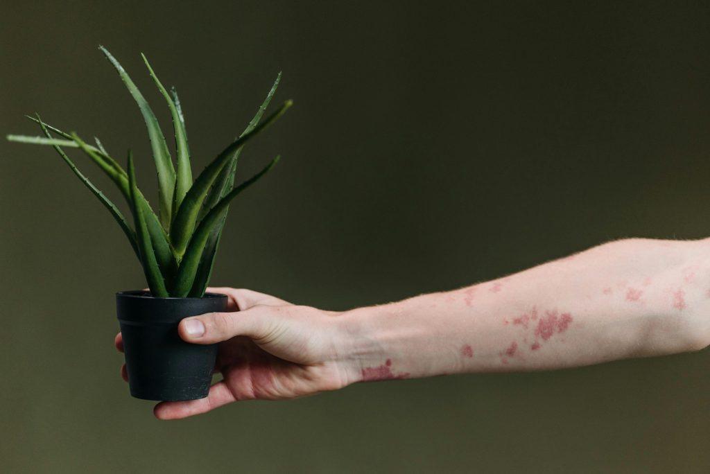 hormonal eczema