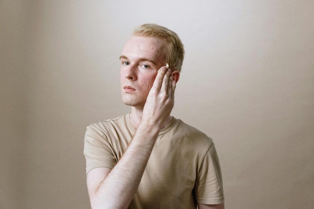 Man With TRT Acne