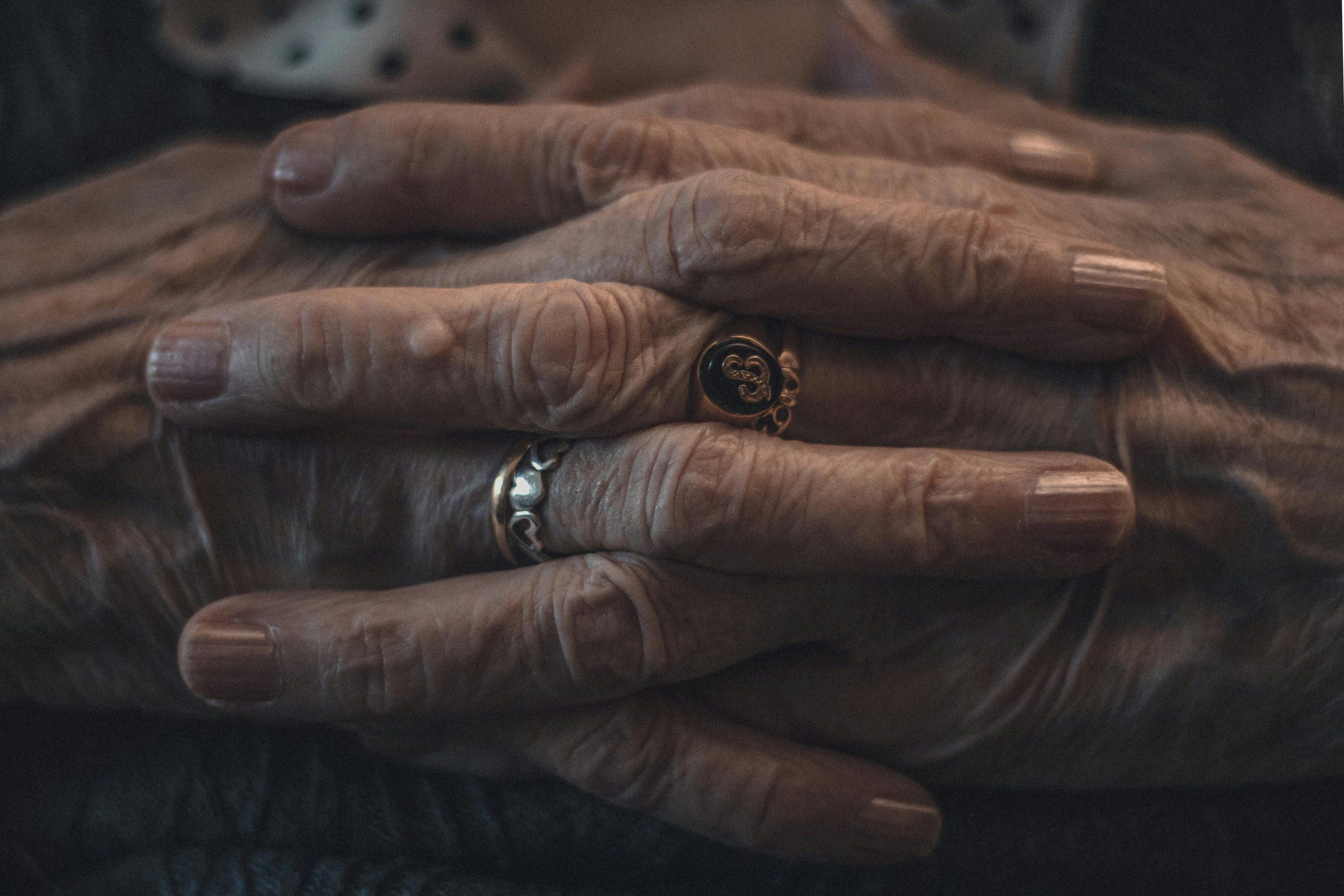 Person clasping hands that have arthritis