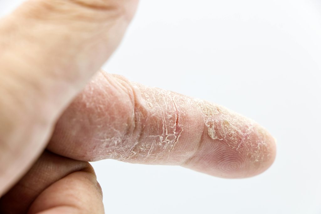 A person's finger with very dry skin
